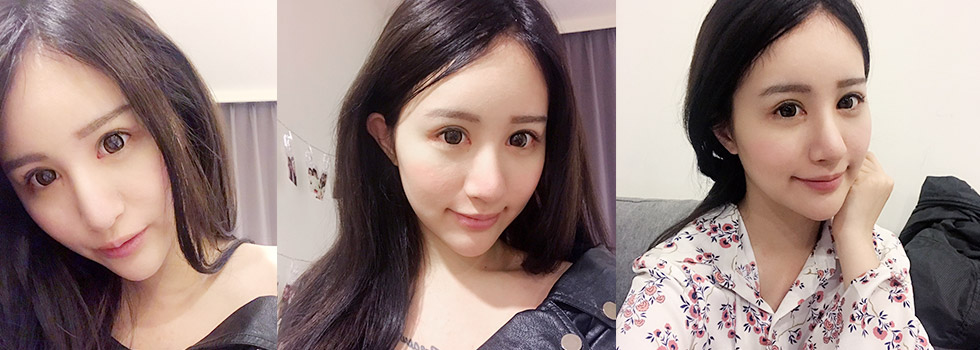 雙膜脈衝光術後生活照