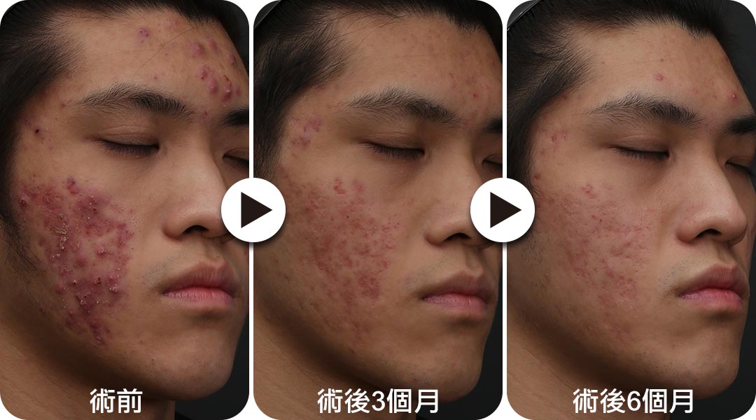 光動力青春痘治療案例-09