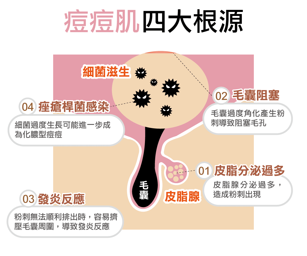 惱人的青春痘症狀