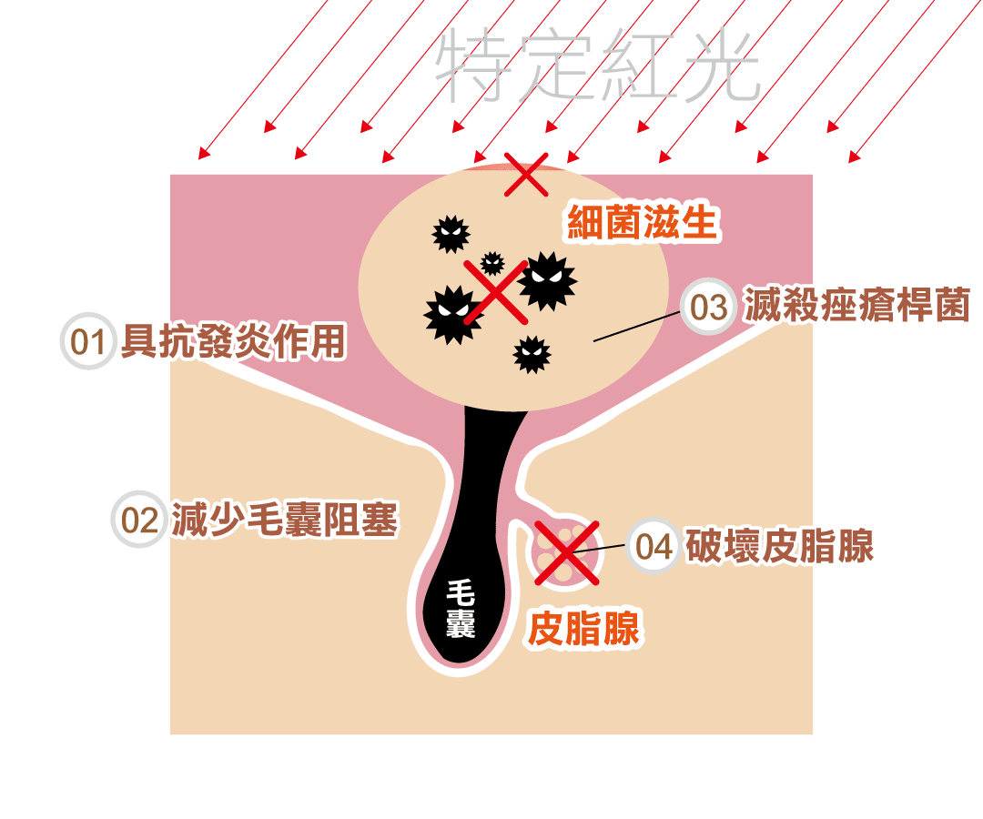 光動力療程治療青春痘原理