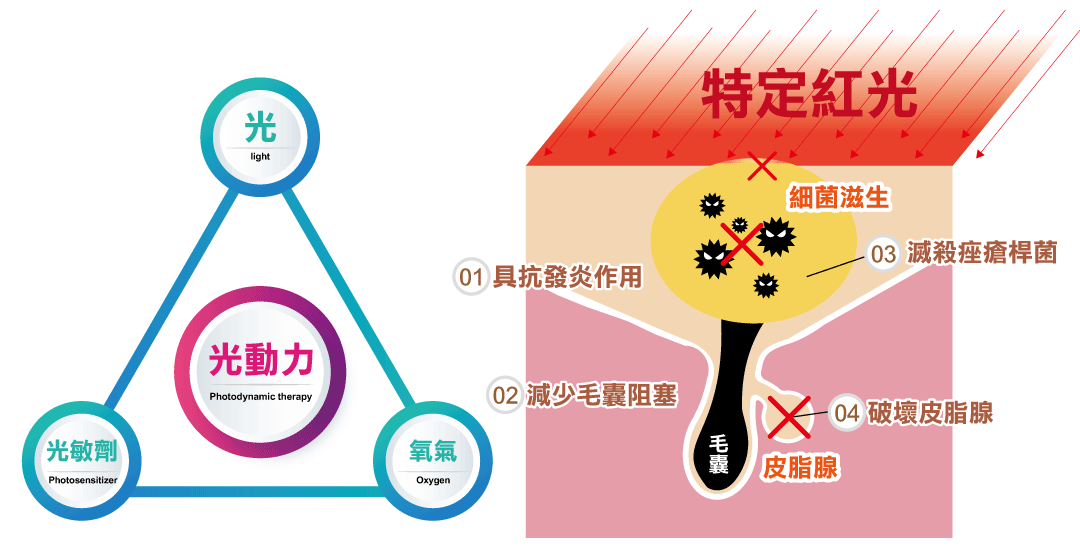 光動力治療青春痘需要三種重要元素