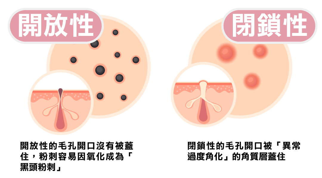 開放性/閉鎖性粉刺差別