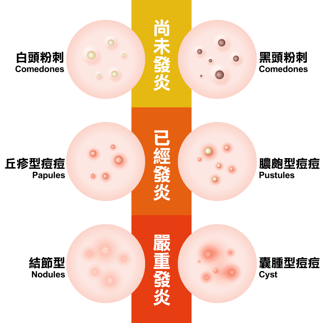 痘痘種類