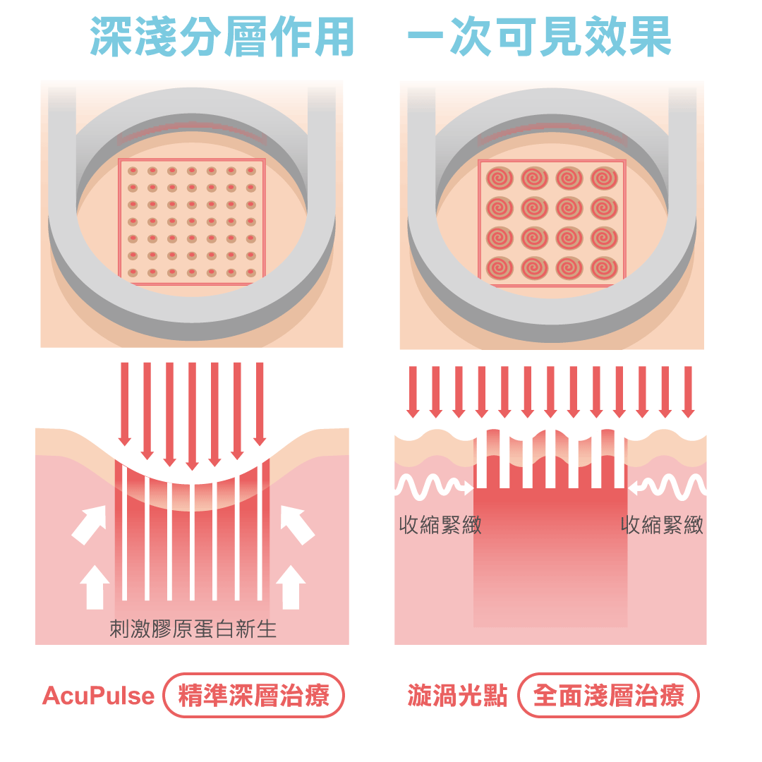 AcuPulse™ CO2 超脈衝雷射治療原理