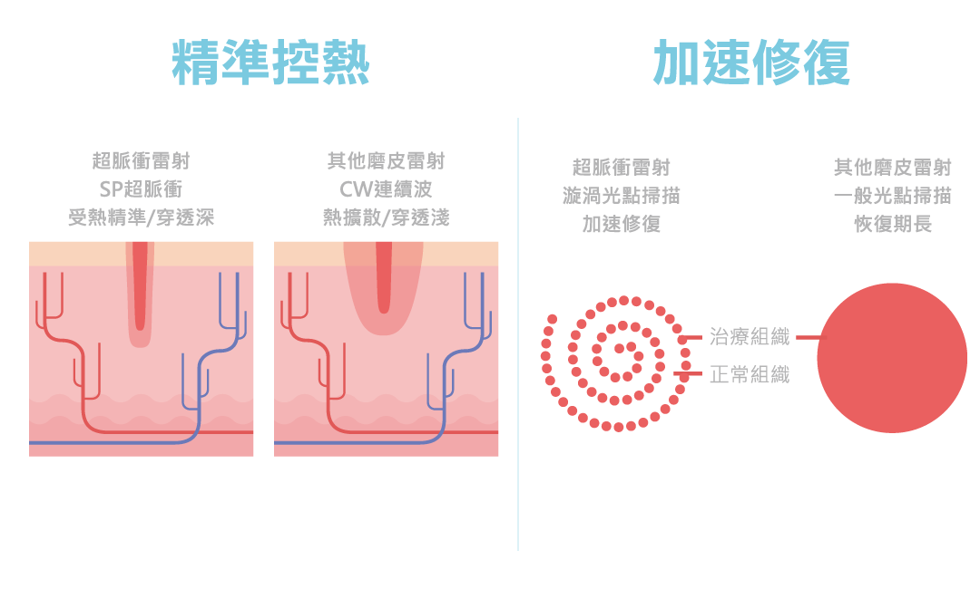 AcuPulse™ CO2 超脈衝雷射超脈衝輸出模式，精準控熱更安全