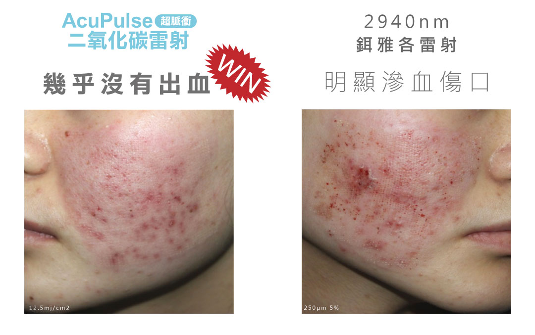 AcuPulse™ CO2 超脈衝雷射超脈衝輸出模式，精準控熱更安全