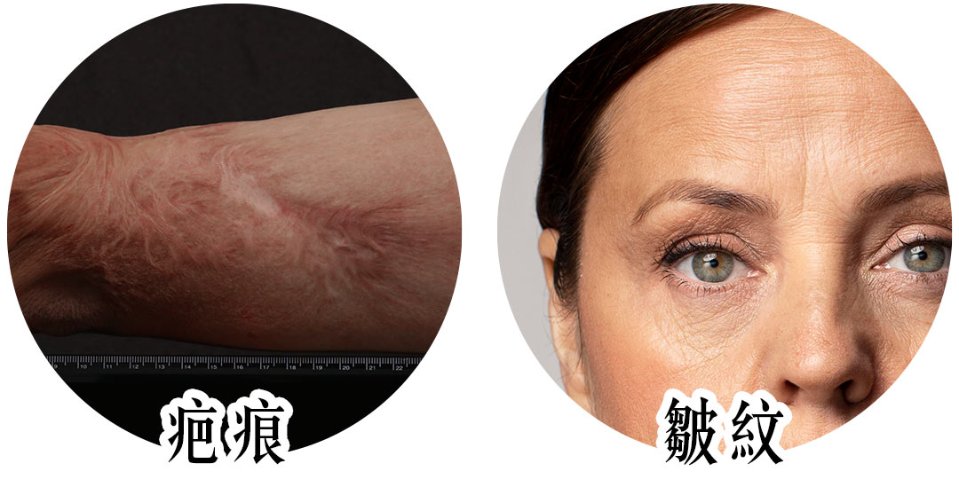 AcuPulse™ CO2 超脈衝雷射治療改善症狀：疤痕皺紋