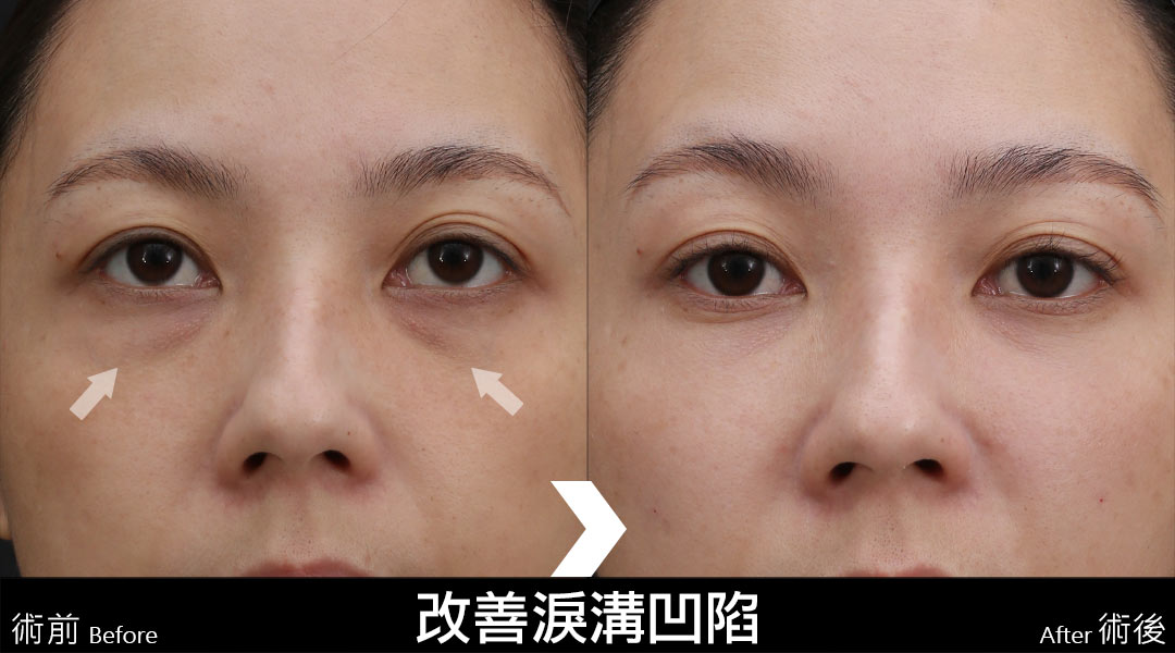 艾麗斯AestheFill®精靈針新型PDLLA聚雙旋乳酸針案例分享-04