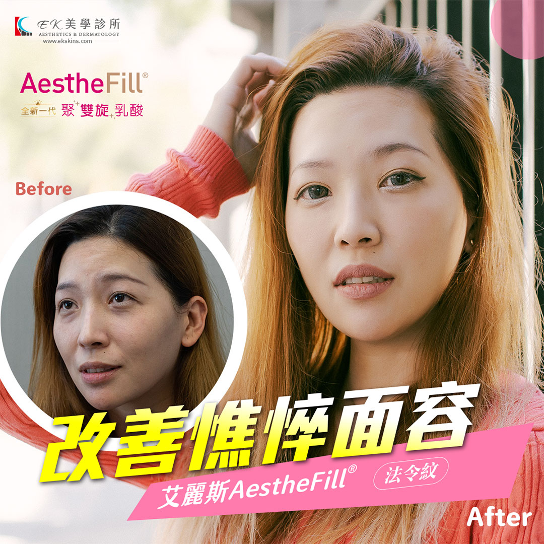 艾麗斯AestheFill®精靈針新型PDLLA聚雙旋乳酸針案例分享-05