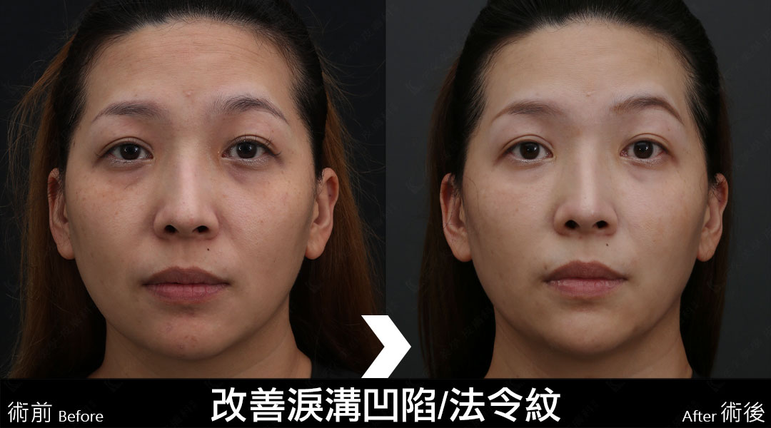 艾麗斯AestheFill®精靈針新型PDLLA聚雙旋乳酸針案例分享-07