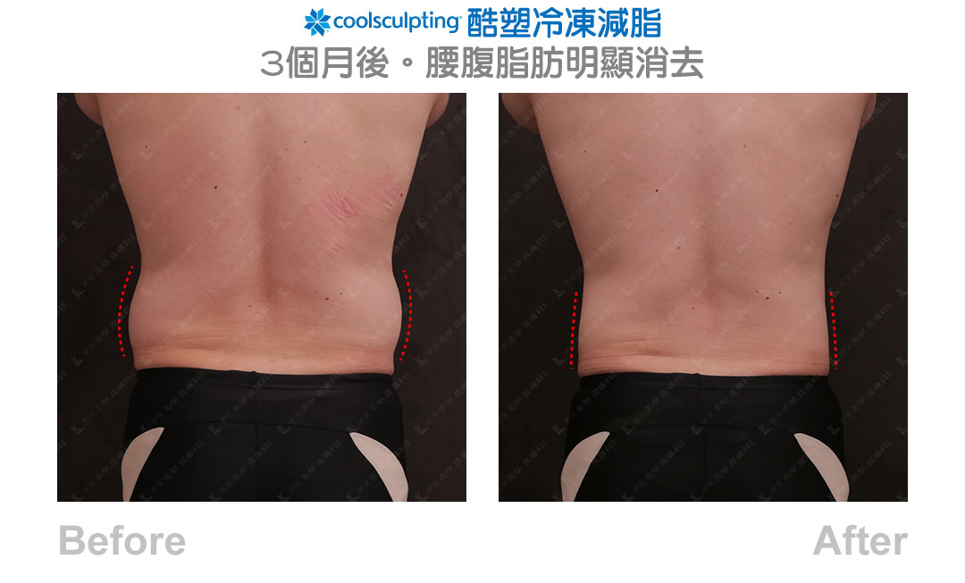 Coolsculpting 酷塑冷凍減脂見證案例-05