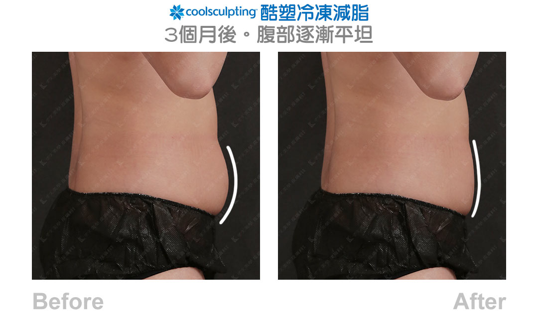 Coolsculpting 酷塑冷凍減脂見證案例-05