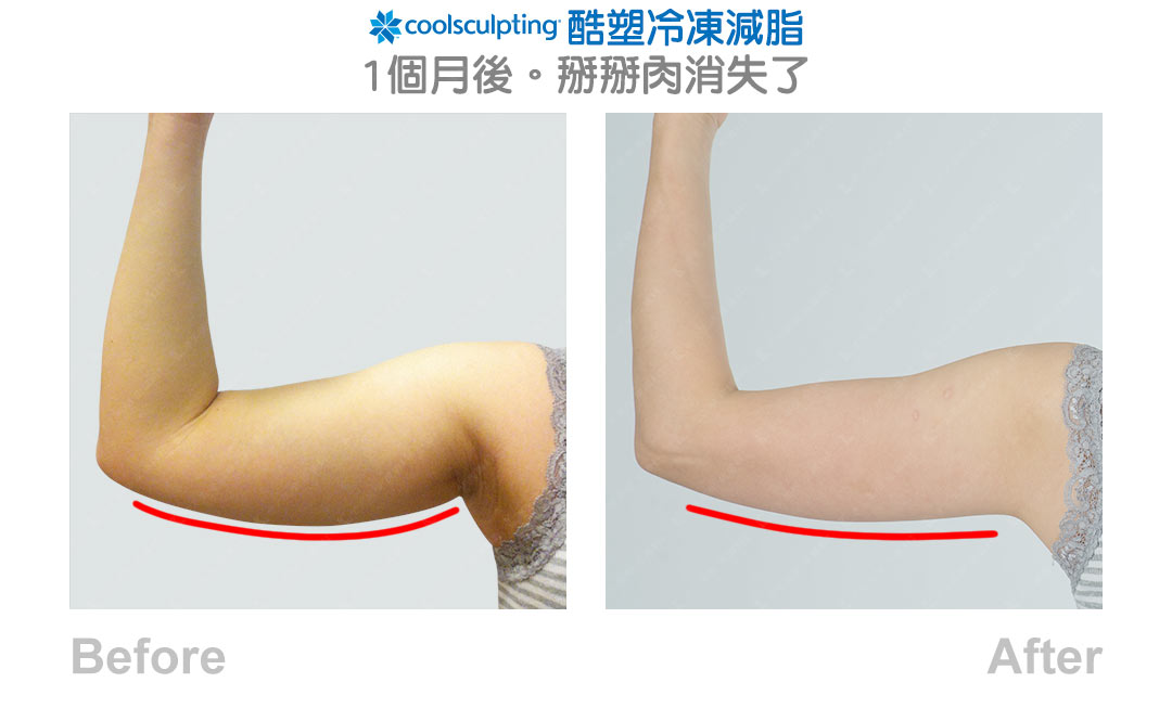 Coolsculpting 酷塑冷凍減脂見證案例-05