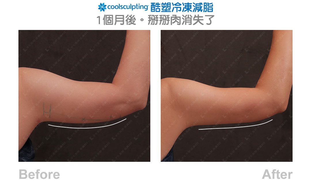 Coolsculpting 酷塑冷凍減脂見證案例-05