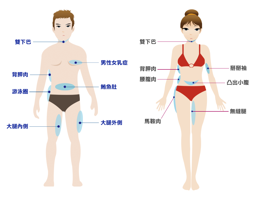 Coolsculpting 酷塑冷凍減脂適用對象