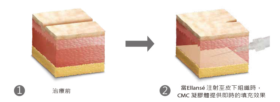 洢蓮絲Ellanse三合一作用機制1