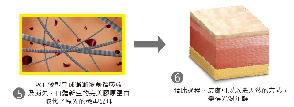 洢蓮絲Ellanse三合一作用機制3