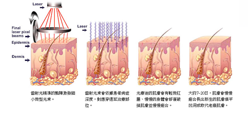 CICU_飛梭雷射原理與深度
