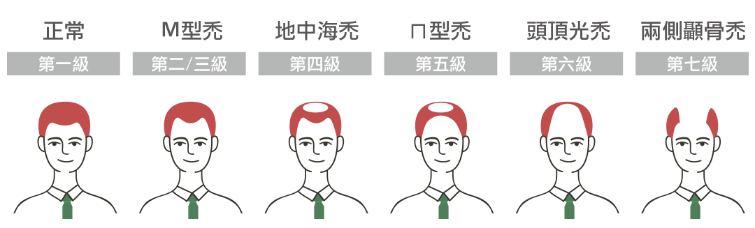 男性雄性禿分期示意圖