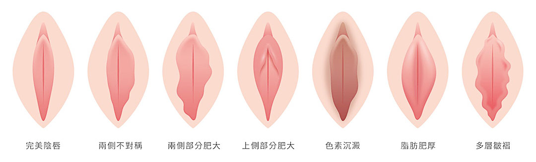 私密處暗沉救星:AcuPulse雷射