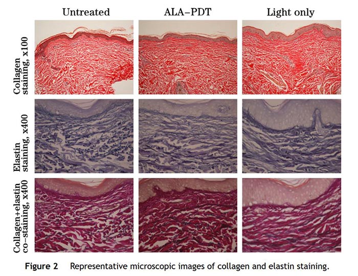 光動力療程治療抗皺原理