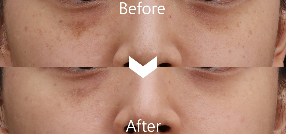 PicoLo皮秒雷射改善臉部色素斑點(老人斑/雀斑/曬斑/肝斑[黃褐斑])-06