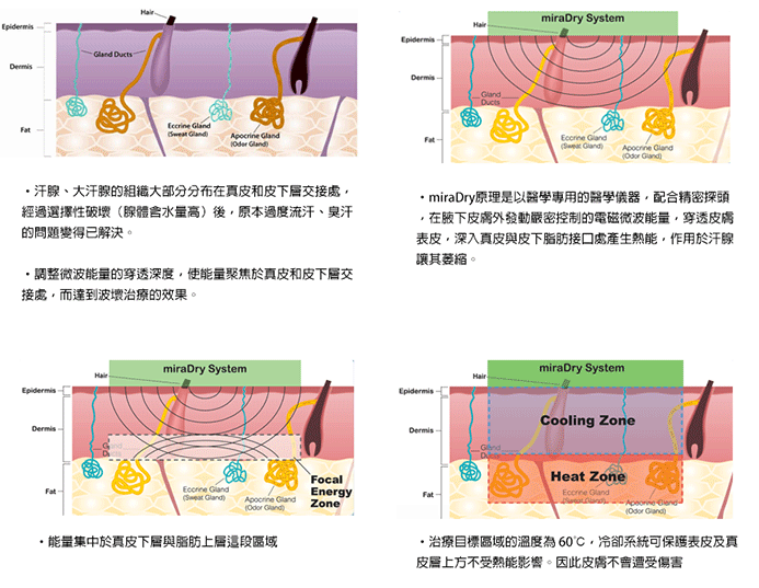 威塑超音波狐臭治療與miraDry比較