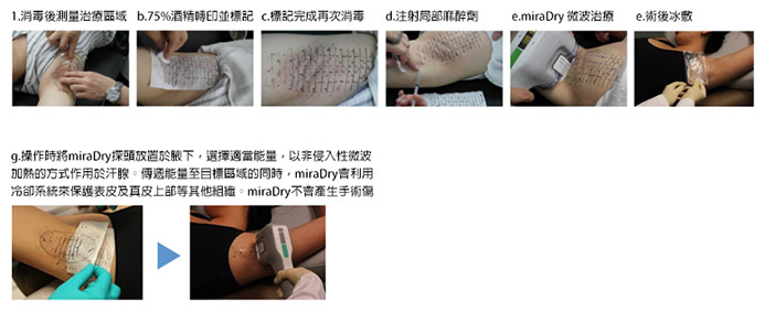 miraDry清新微波｜腋淨爽治療步驟