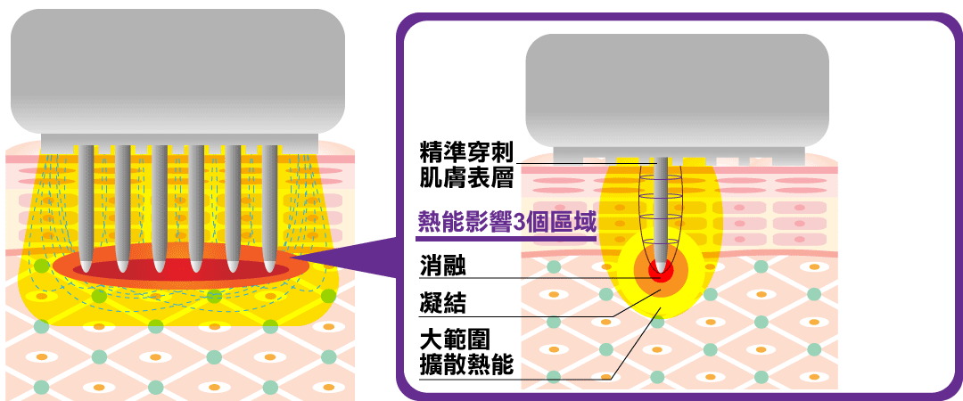 微針電波：墨菲斯