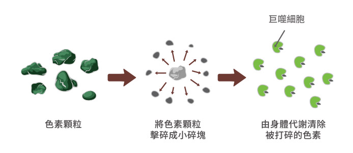 D.O.E.光繞雷射擊碎黑色素