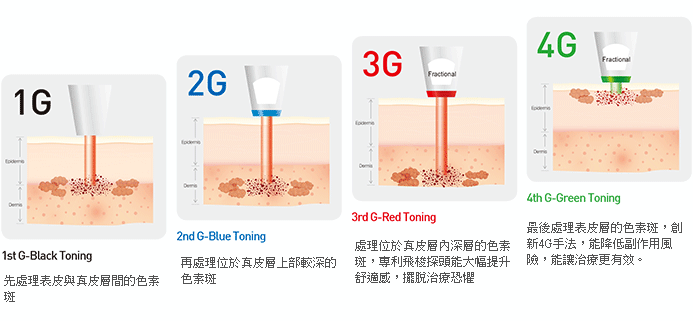 D.O.E.光繞雷射治療4G模式