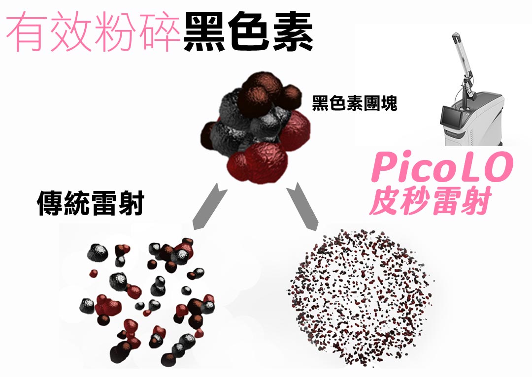 皮秒雷射有效粉碎黑色素