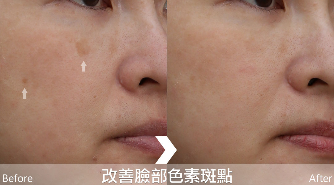 PicoLo皮秒雷射改善臉部色素斑點(老人斑/雀斑/曬斑/肝斑[黃褐斑])-07