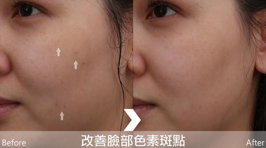 PicoLo皮秒雷射改善臉部色素斑點(老人斑/雀斑/曬斑/肝斑[黃褐斑])-08