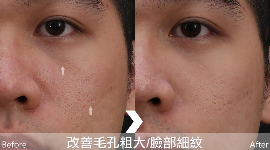 PicoLo皮秒雷射改善毛孔粗大臉部細紋問題