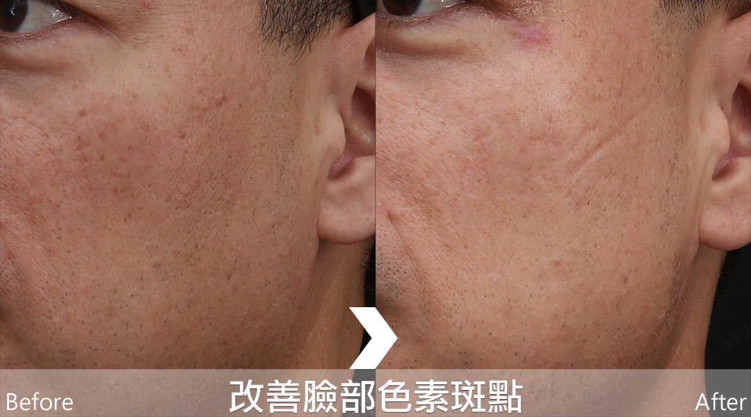 PicoLo皮秒雷射改善臉部色素斑點(老人斑/雀斑/曬斑/肝斑[黃褐斑])-01