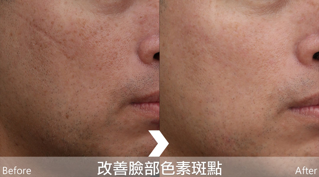PicoLo皮秒雷射改善臉部色素斑點(老人斑/雀斑/曬斑/肝斑[黃褐斑])-02