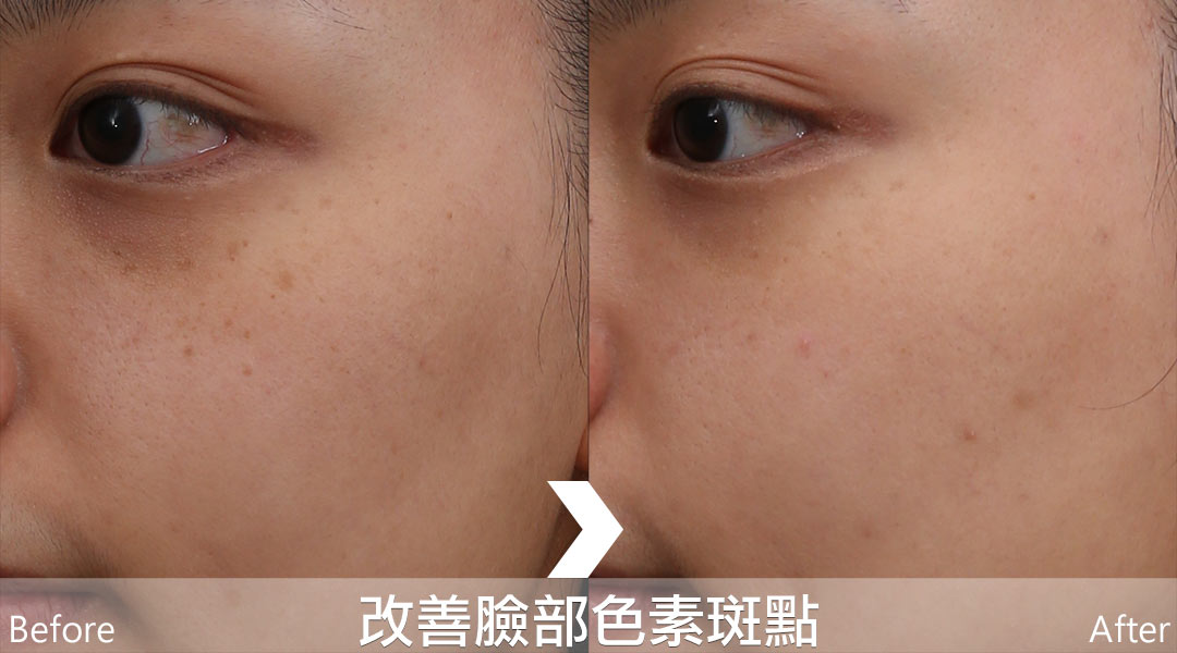 PicoLo皮秒雷射改善臉部色素斑點(老人斑/雀斑/曬斑/肝斑[黃褐斑])-05