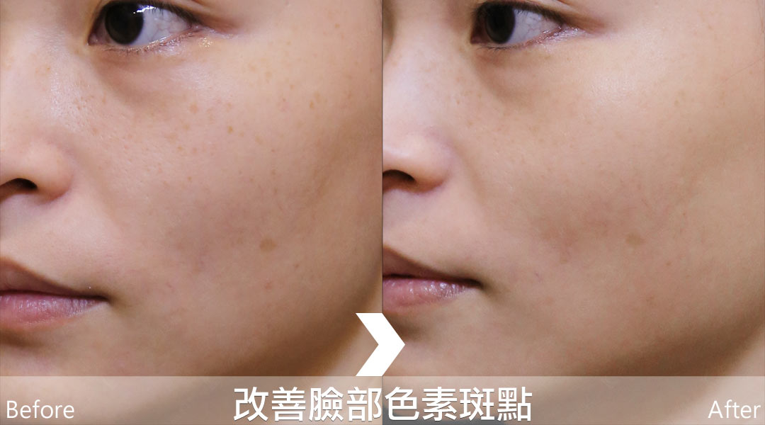 PicoLo皮秒雷射改善臉部色素斑點(老人斑/雀斑/曬斑/肝斑[黃褐斑])-09