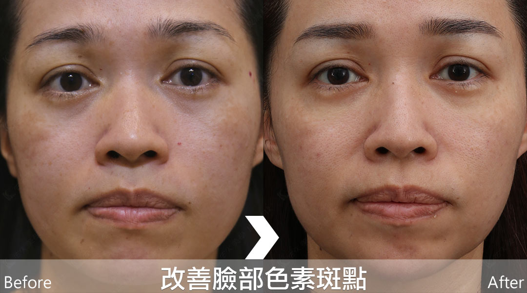PicoLo皮秒雷射改善臉部色素斑點(老人斑/雀斑/曬斑/肝斑[黃褐斑])-10