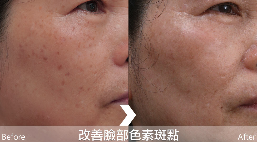 PicoLo皮秒雷射改善臉部色素斑點(老人斑/雀斑/曬斑/肝斑[黃褐斑])-11
