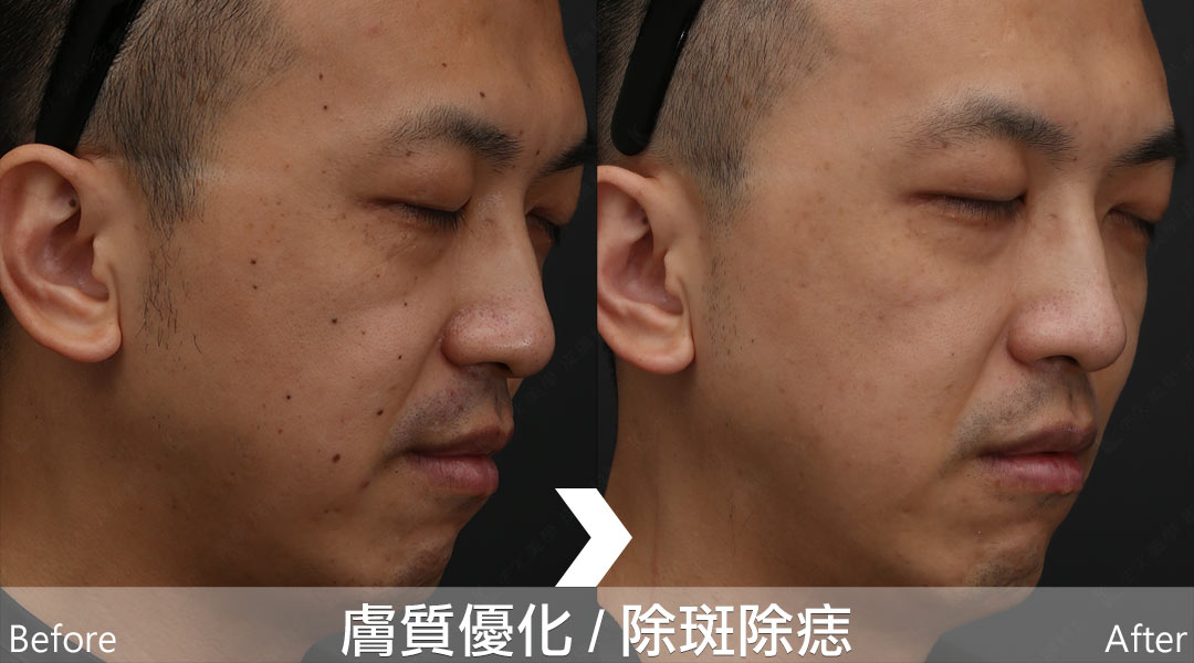 PicoLo皮秒雷射改善臉部膚質狀況、除斑除痣