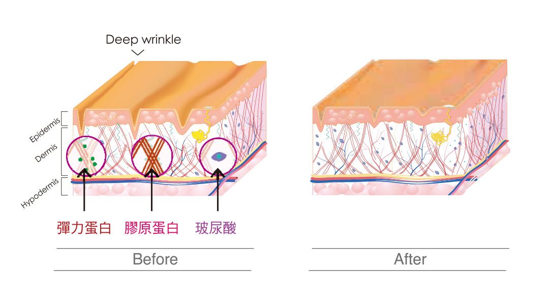 Profound魔方電波施特色膠原蛋白Before&After