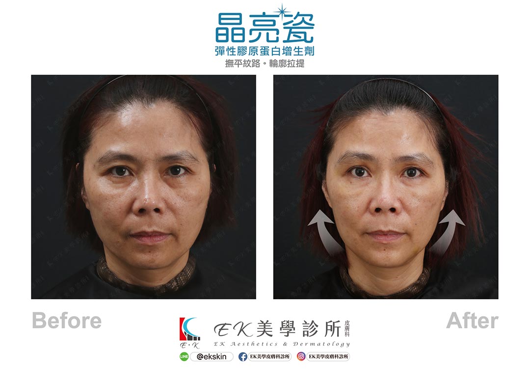 EK美學皮膚科診所晶亮瓷輪廓拉提案例-01 EK美學皮膚科診所晶亮瓷輪廓拉提案例-01