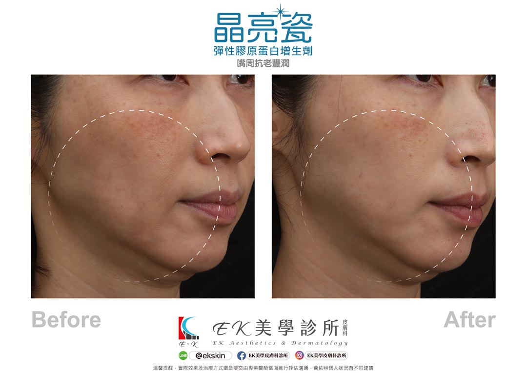 EK美學皮膚科診所晶亮瓷嘴周抗老豐潤案例-01 EK美學皮膚科診所晶亮瓷嘴周抗老豐潤案例-01