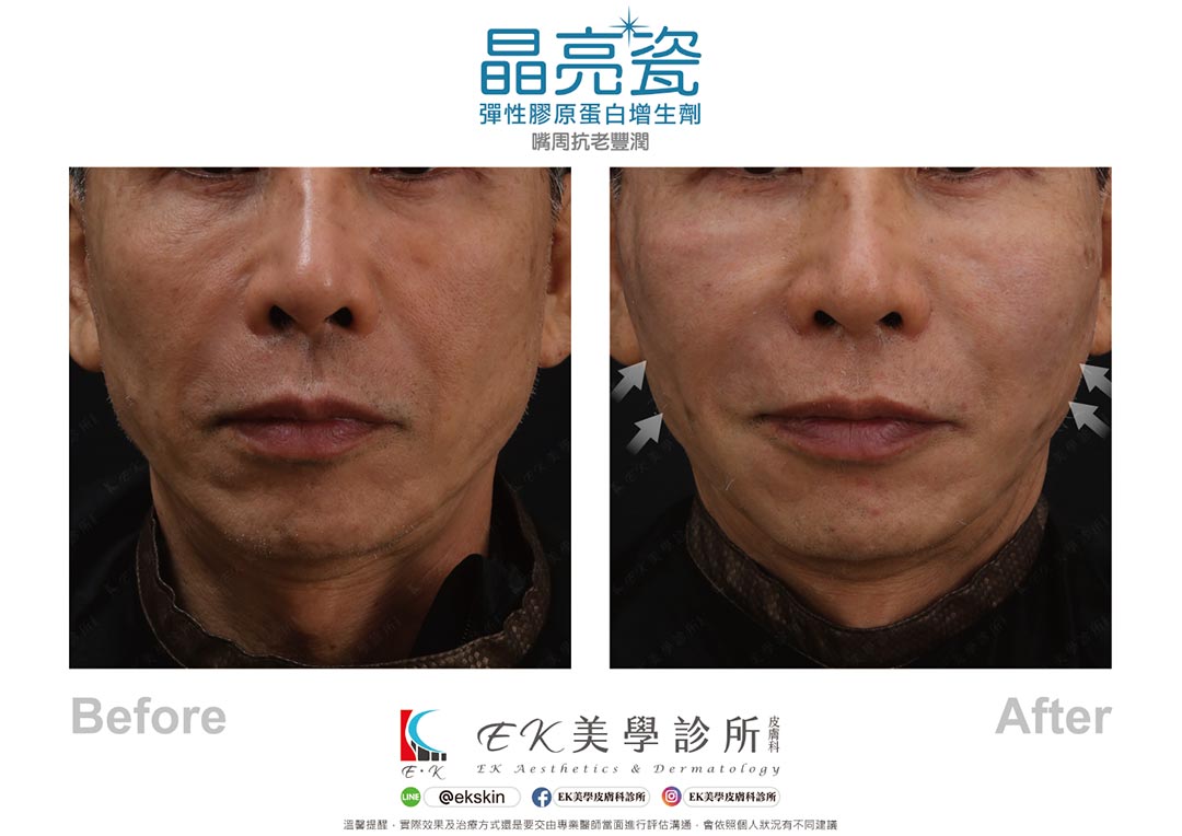 EK美學皮膚科診所晶亮瓷嘴周抗老豐潤案例-03 EK美學皮膚科診所晶亮瓷嘴周抗老豐潤案例-03