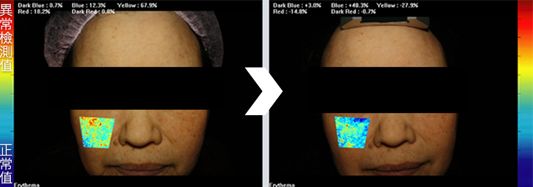 酒糟皮膚檢測儀比較圖
