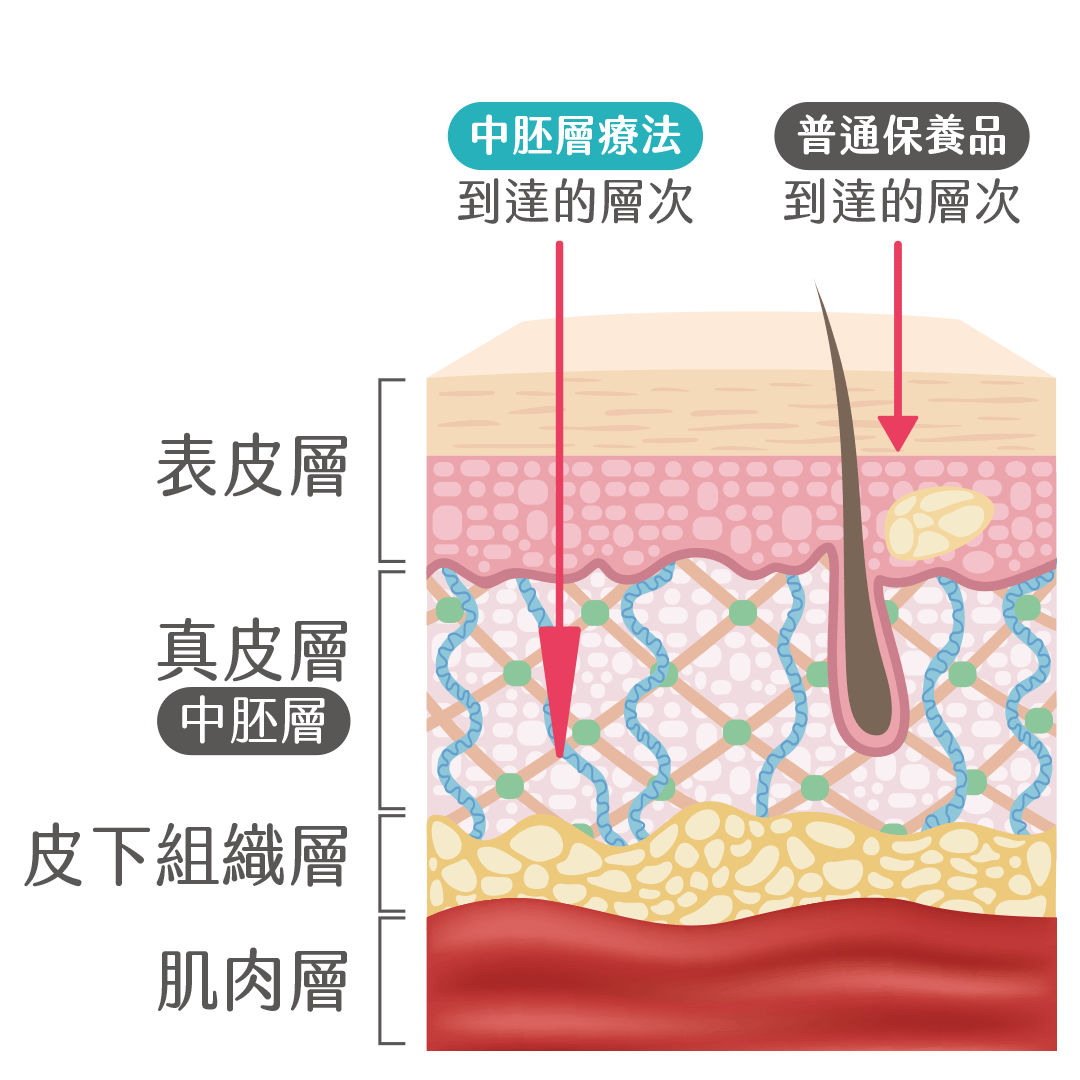肝斑中胚層療法皮膚分層架構圖示說明