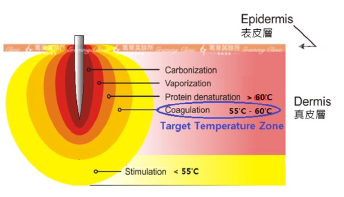 電波拉皮治療溫度表(2)