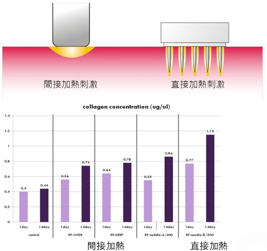 電波拉皮直接加熱與間接加熱比較圖表